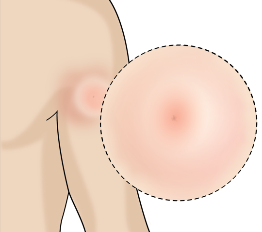 Illustration of an tick bite on a human